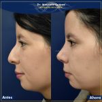 Beneficios de una Rinoplastia ó Operación de naríz