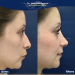 Resultados Rinoplastia o Rinoplastia Ultrasónica Colombia