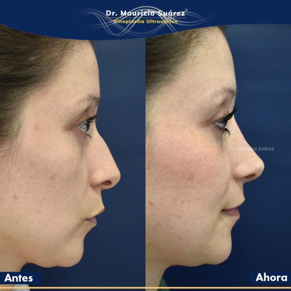 Resultados Rinoplastia o Rinoplastia Ultrasónica Colombia