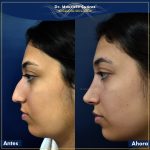 Resultados Rinoplastia o Rinoplastia Ultrasónica Colombia