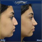 Resultados Rinoplastia o Rinoplastia Ultrasónica Colombia