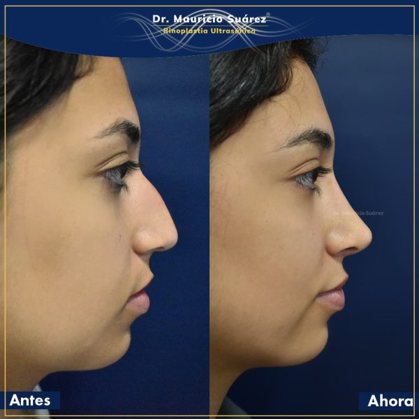 Resultados Rinoplastia o Rinoplastia Ultrasónica Colombia
