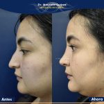 Resultados Rinoplastia o Rinoplastia Ultrasónica Colombia