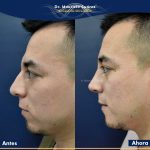 Resultados Rinoplastia o Rinoplastia Ultrasónica Colombia