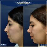 Resultados cirugia rinoplastia ó operación de naríz