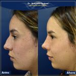 Resultados Rinoplastia o Rinoplastia Ultrasónica Colombia