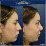 Resultados Rinoplastia o Operación de Naríz Bogotá