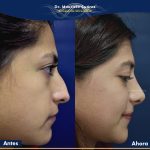 Resultados Rinoplastia o Rinoplastia Ultrasónica Colombia