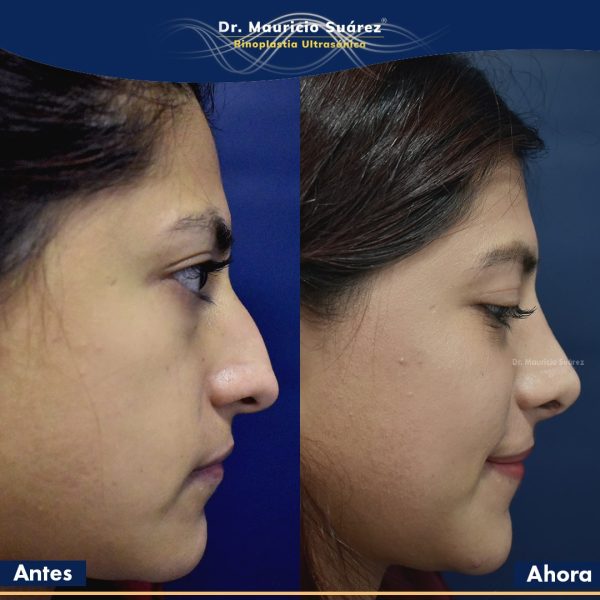 Resultados Rinoplastia o Rinoplastia Ultrasónica Colombia