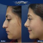 Resultados Rinoplastia o Rinoplastia Ultrasónica Colombia